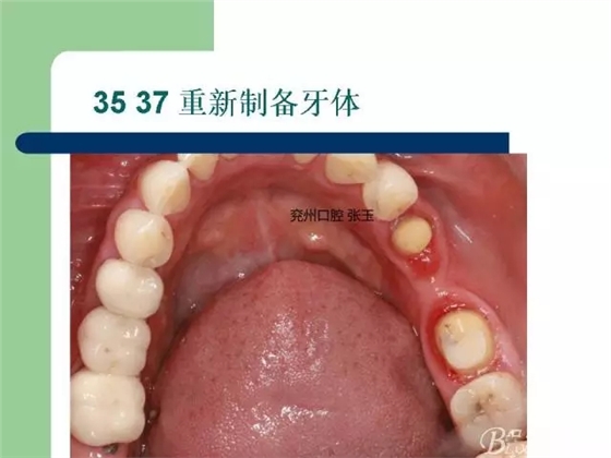 左下后牙不良修复体拆除后重新修复一例