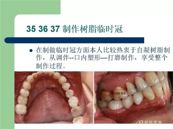 左下后牙不良修复体拆除后重新修复一例