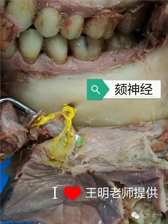 贡献及其珍贵的上颌窦解剖照片