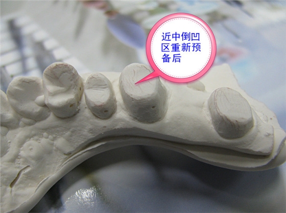 口腔修复医生备牙取摸常见问题系列之——基牙倒凹 与 备牙时“就位道”的处理