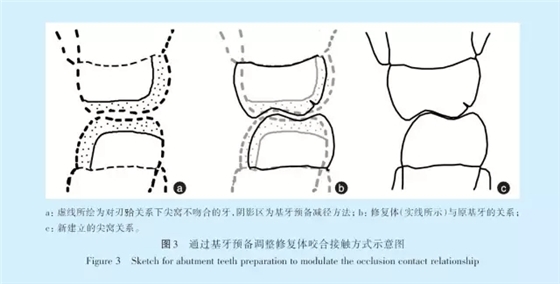 王美青.浅谈咬合修复重建中的（牙合）学问题