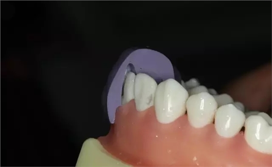 硅橡胶导板——牙体预备步骤详解