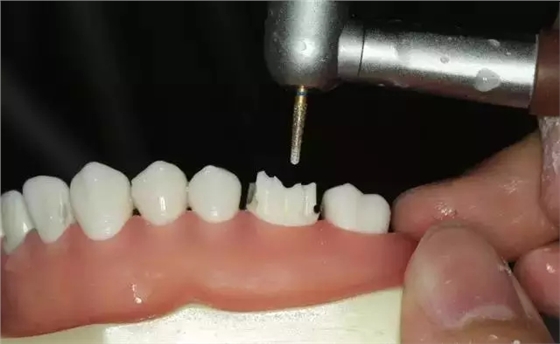 硅橡胶导板——牙体预备步骤详解