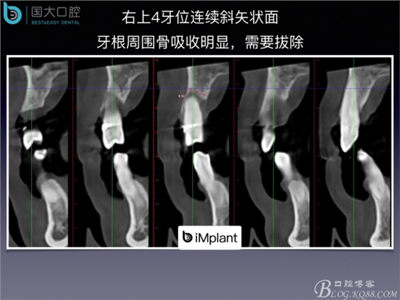 上颌窦底区域严重骨吸收的临床种植案例.jpeg