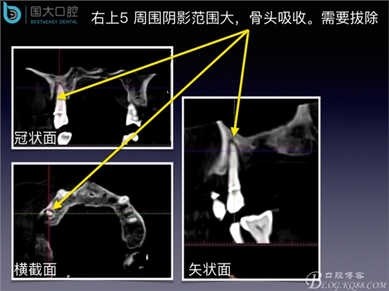 上颌窦底区域严重骨吸收的临床种植案例.jpeg