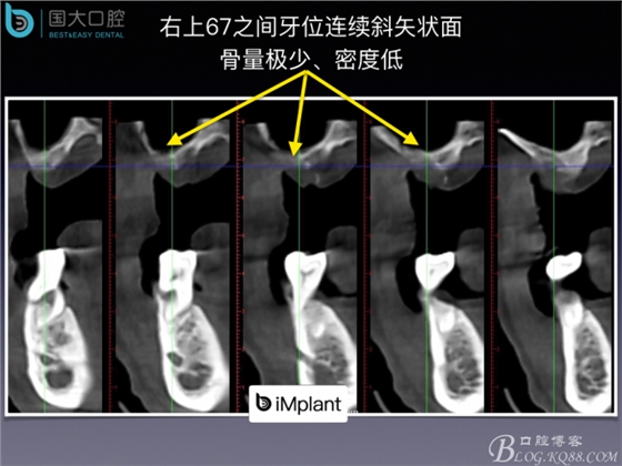 上颌窦底区域严重骨吸收的临床种植案例.jpeg