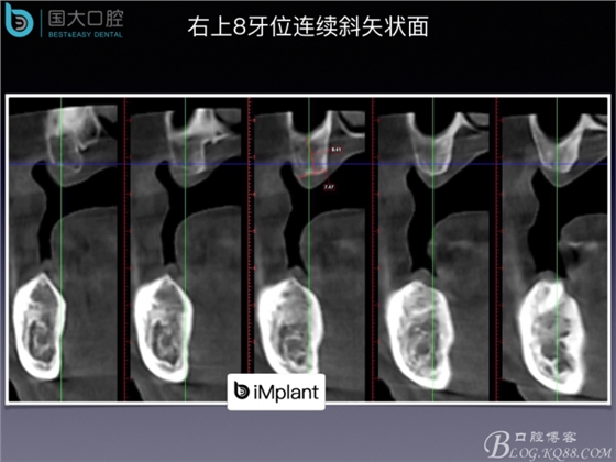 上颌窦底区域严重骨吸收的临床种植案例.jpeg