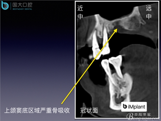 上颌窦底区域严重骨吸收的临床种植案例.jpeg