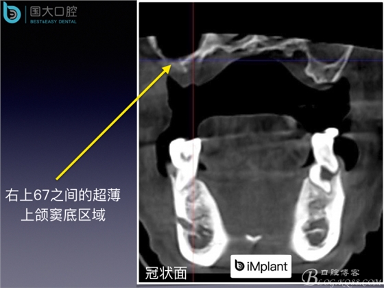 上颌窦底区域严重骨吸收的临床种植案例.jpeg