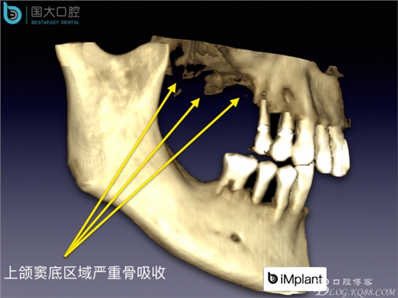 上颌窦底区域严重骨吸收的临床种植案例.jpeg