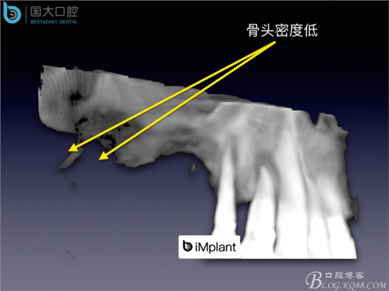 上颌窦底区域严重骨吸收的临床种植案例.jpeg