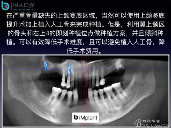 上颌窦底区域严重骨吸收的临床种植案例.jpeg