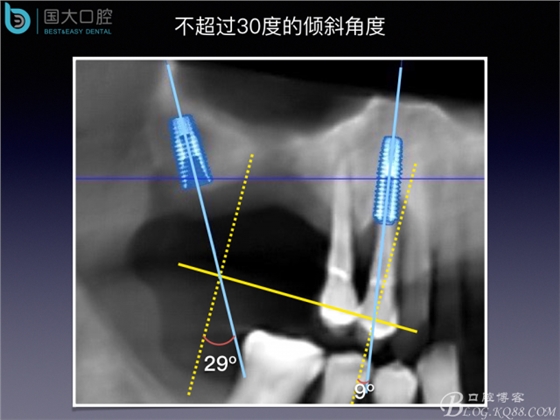 上颌窦底区域严重骨吸收的临床种植案例.jpeg