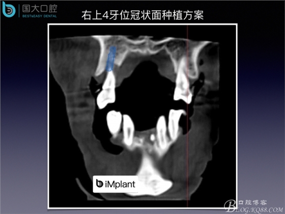 上颌窦底区域严重骨吸收的临床种植案例.jpeg