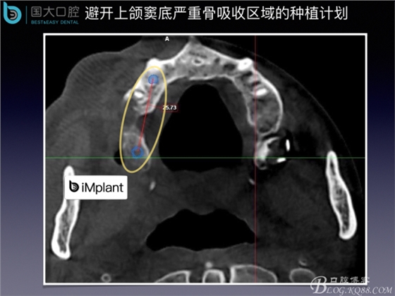 上颌窦底区域严重骨吸收的临床种植案例.jpeg