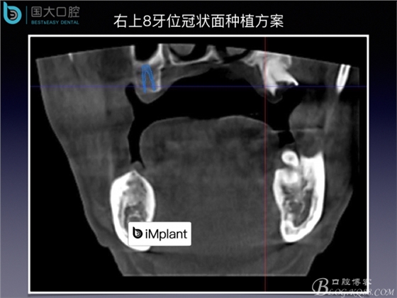 上颌窦底区域严重骨吸收的临床种植案例.jpeg