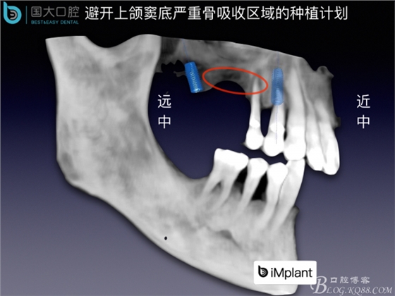 上颌窦底区域严重骨吸收的临床种植案例.jpeg