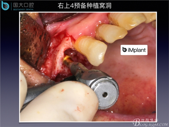 上颌窦底区域严重骨吸收的临床种植案例.jpeg