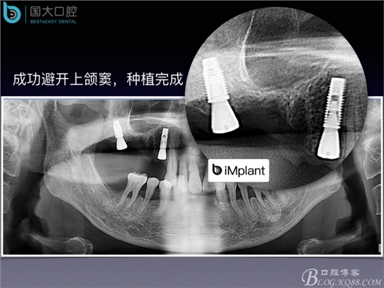 上颌窦底区域严重骨吸收的临床种植案例.jpeg