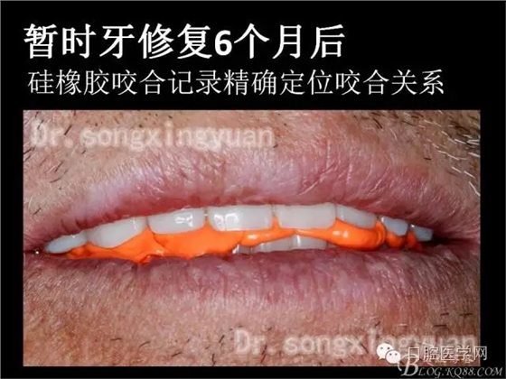 种植牙全口咬合重建