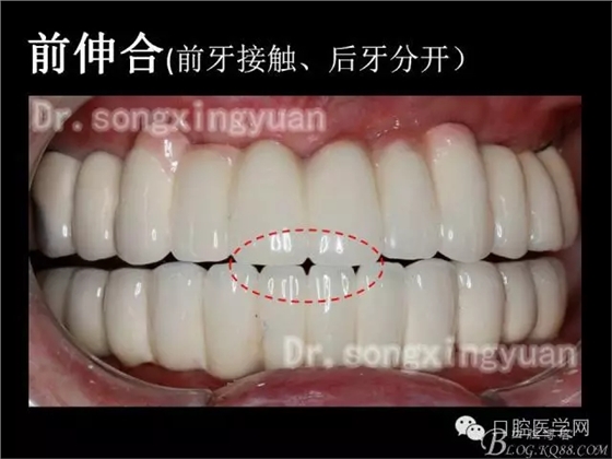 种植牙全口咬合重建