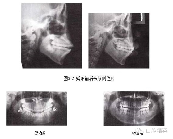 拔牙矫治开颌伴前突