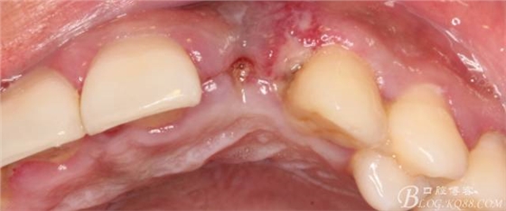 【征文大赛】一例上前牙种植失败病例的补救--梁光强