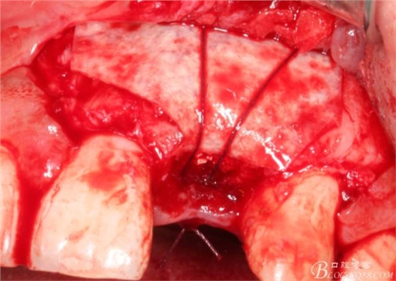 【征文大赛】一例上前牙种植失败病例的补救--梁光强