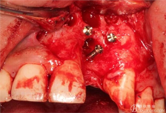 【征文大赛】一例上前牙种植失败病例的补救--梁光强