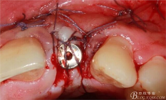【征文大赛】一例上前牙种植失败病例的补救--梁光强