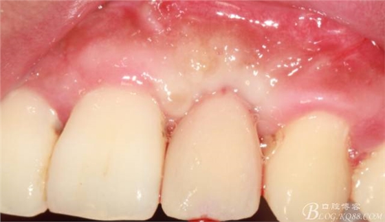 【征文大赛】一例上前牙种植失败病例的补救--梁光强