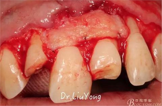 3山西牙周刘勇：“前牙外伤患者的口腔多学科联合治疗”精彩案例分享