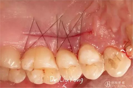 3山西牙周刘勇：“前牙外伤患者的口腔多学科联合治疗”精彩案例分享