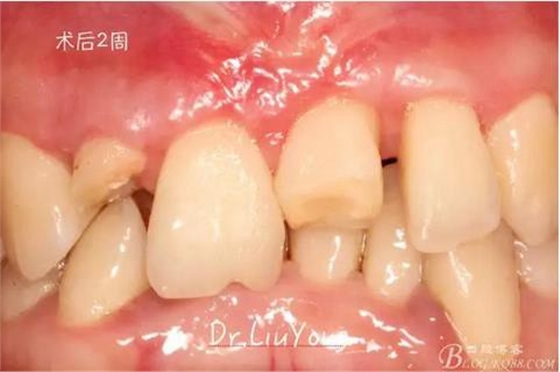 山西牙周刘勇：“前牙外伤患者的口腔多学科联合治疗”精彩案例分享