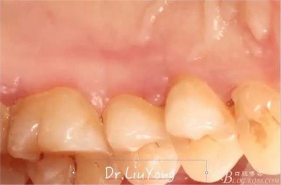 山西牙周刘勇：“前牙外伤患者的口腔多学科联合治疗”精彩案例分享