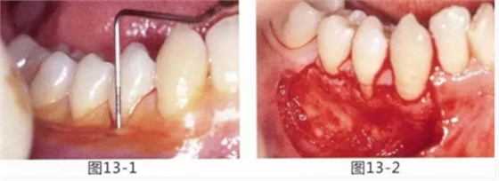 FGG法增大附着龈及根面覆盖【牙龈－牙槽黏膜的问题】