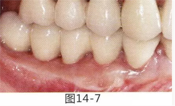 FGG法增大附着龈及根面覆盖【牙龈－牙槽黏膜的问题】