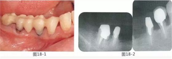 FGG法增大附着龈及根面覆盖【牙龈－牙槽黏膜的问题】