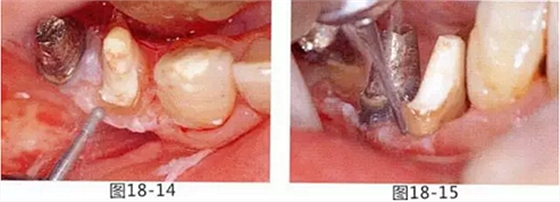 FGG法增大附着龈及根面覆盖【牙龈－牙槽黏膜的问题】