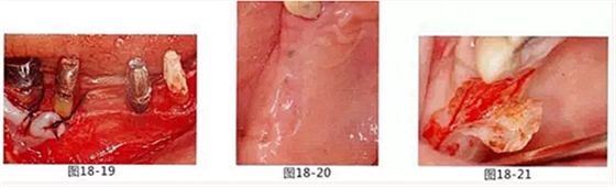 FGG法增大附着龈及根面覆盖【牙龈－牙槽黏膜的问题】