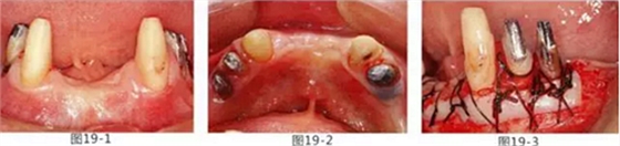 FGG法增大附着龈及根面覆盖【牙龈－牙槽黏膜的问题】