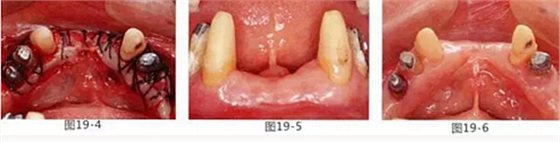 FGG法增大附着龈及根面覆盖【牙龈－牙槽黏膜的问题】