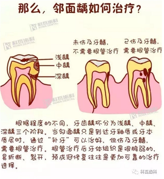 牙缝间的黑线是邻面龋，还一坏坏俩，巧用它帮你渡过一“劫”