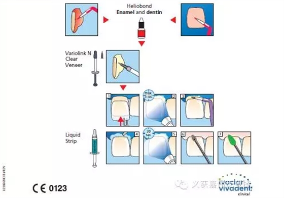 义获嘉贴面粘接的操作步骤！