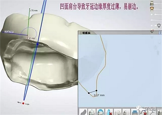 影响全瓷牙冠裂的因素有哪些？