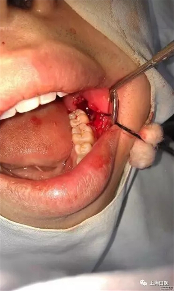 拔牙干槽症可怕吗