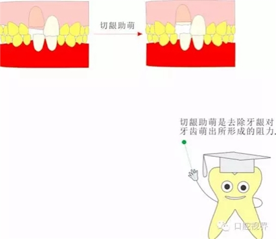  “什么是牙周袋冲洗？”