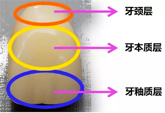 三层色树脂牙.png