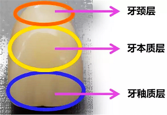 四层色树脂牙.png