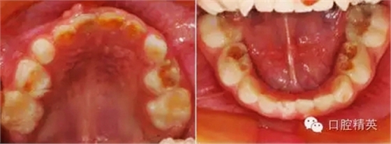 全麻下儿科治疗+儿牙树脂充填
